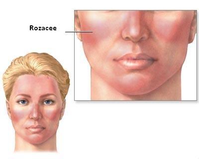 acneea rozacee
